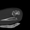 SPORK, NICO - 22.03.1976 - 02.08.2022 - CT obere Extremität - 18:02:23